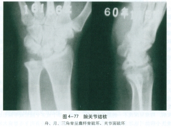 骨与关节结核考研重点